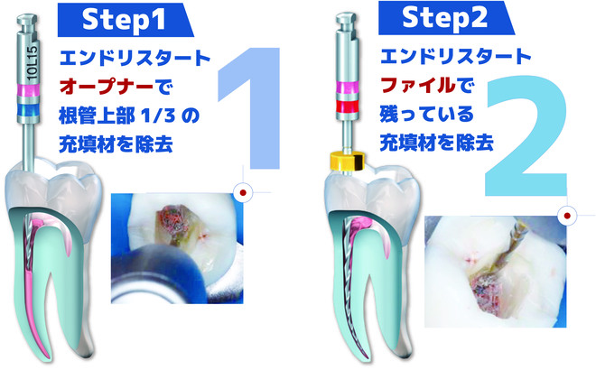 コメット エンドリスタート / 総合歯科材料商社 株式会社モモセ歯科商会